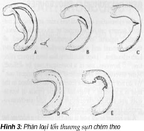 Tổn thương sụn chêm