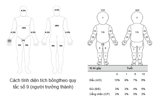 Diện Tích Bỏng Tính Theo Quy Tắc Số 9 (người Trưởng Thành) Và Trẻ Em