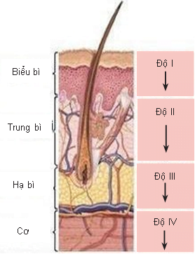 Độ Sâu Của Tổn Thương Bỏng