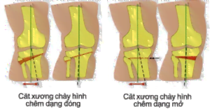 Cắt Xương Sửa Trục