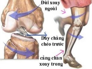 Cơ Chế đứt Dây Chằng Chéo Trước