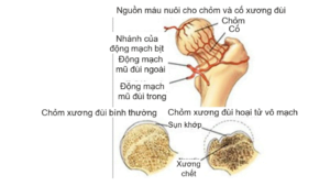 Hoại Tử Chỏm Xương đùi Do Thiếu Máu Nuôi Gây Sụp Chỏm