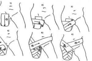 Kỹ Thuật Băng Mỏm Cụt Trên Gối [3]