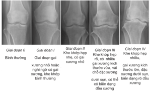 Phân Loại Mức độ Thoái Hóa Dựa Trên X-quang Theo Tác Giả Kellgren Và Lawrence