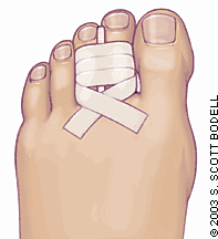 Káº¿t quáº£ hÃ¬nh áº£nh cho toes fracture immobilization