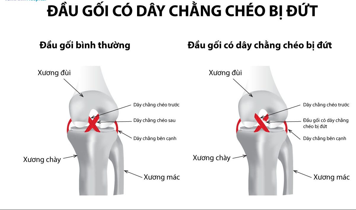 Dây Chằng Chéo