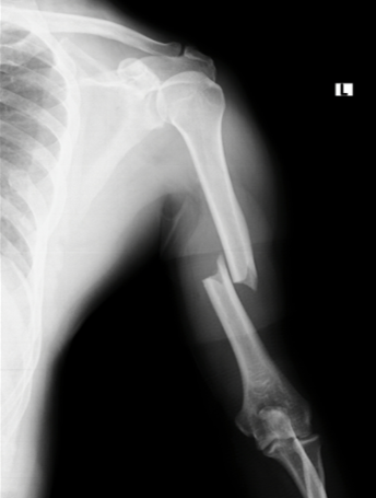 X-ray of a shoulder boneDescription automatically generated