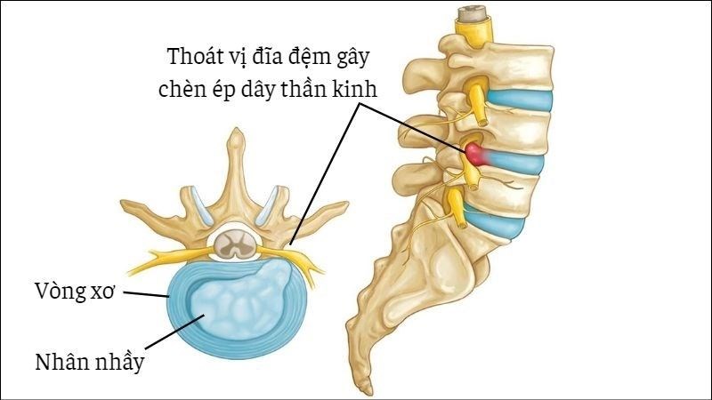 Thoát Vị đĩa đệm Là Gì Dấu Hiệu Thoát Vị đĩa đệm 2