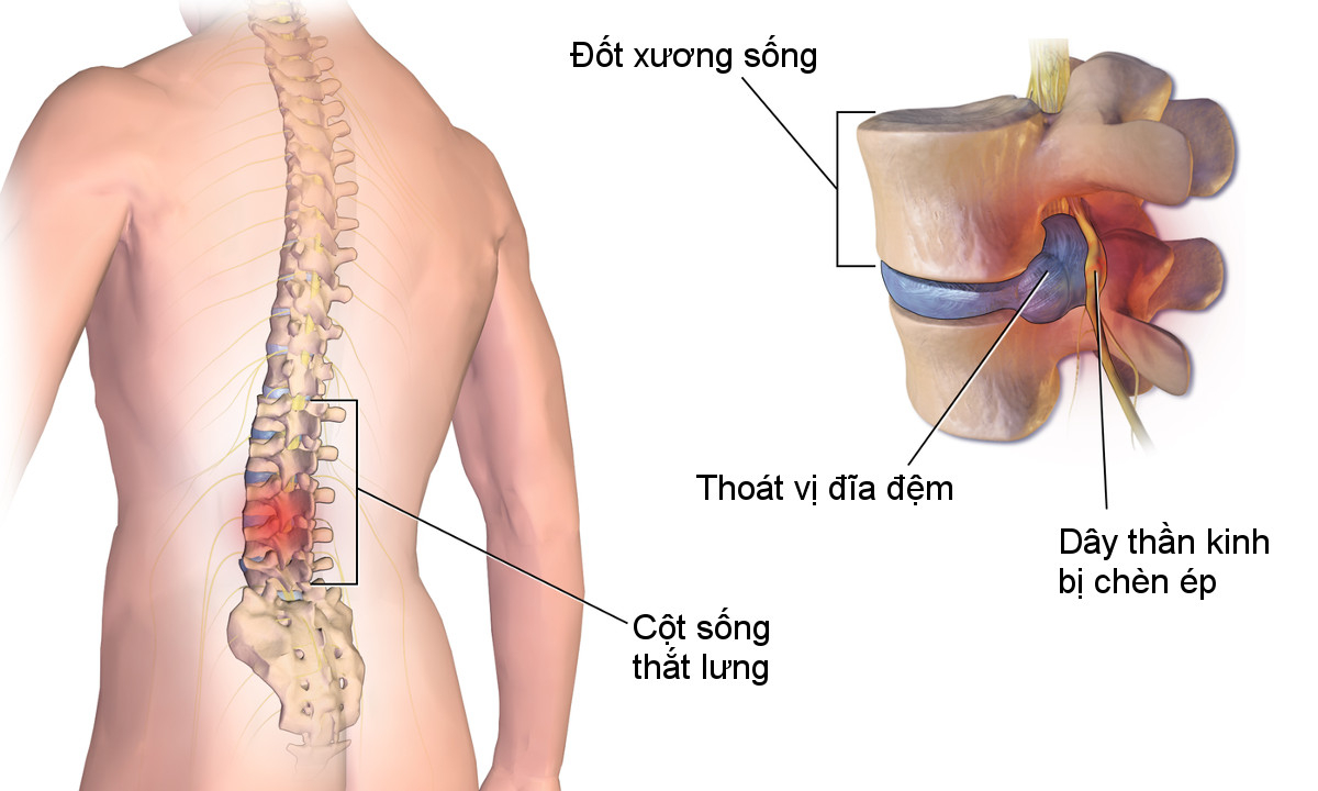 Thoát Vị đĩa đệm