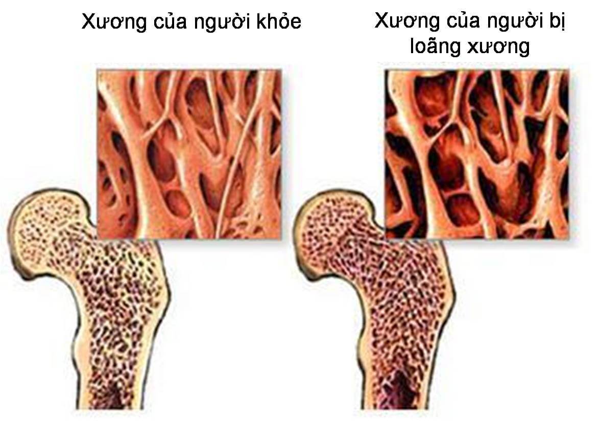 Xương Khớp Thiếu Canxi