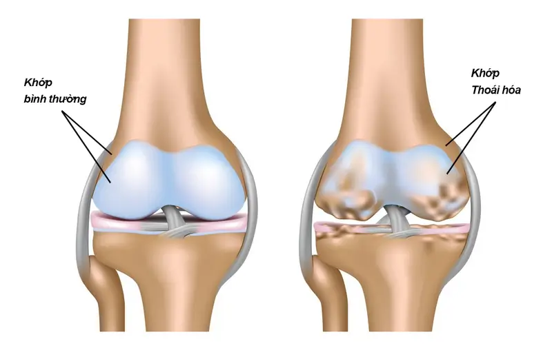 Cách điều Trị đau Nhức Xương Khớp Tại Nhà Một Cách Hiệu Quả 1