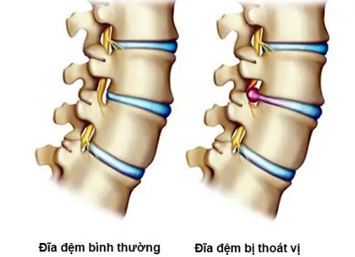 Đau Nhức Xương Khớp 2