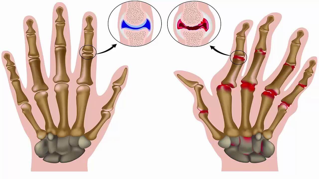 Đau Nhức Xương Khớp 3