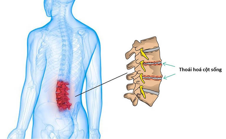 Đau Nhức Xương Khớp 4