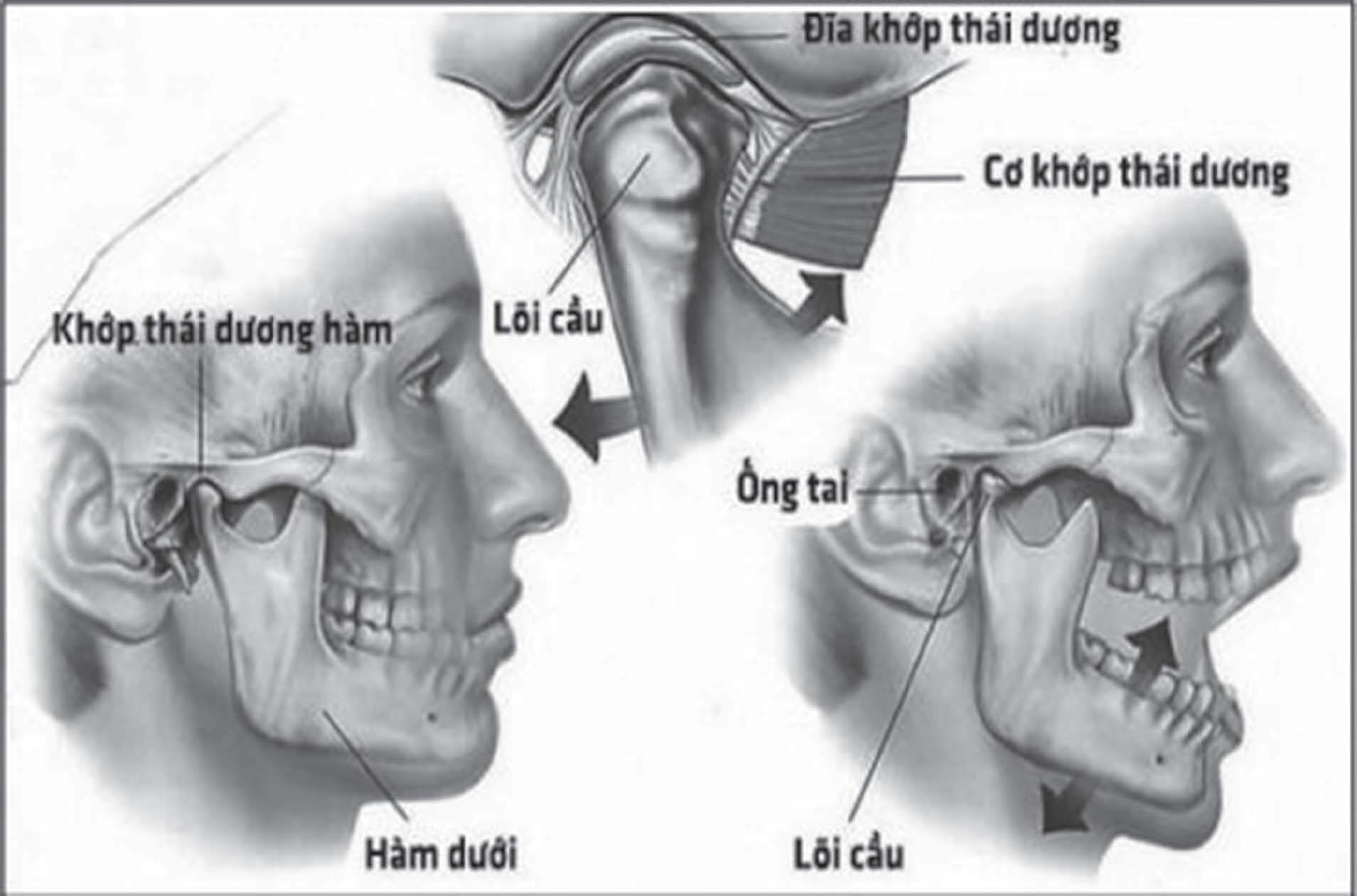 Viêm Khớp Thái Dương Hàm 1