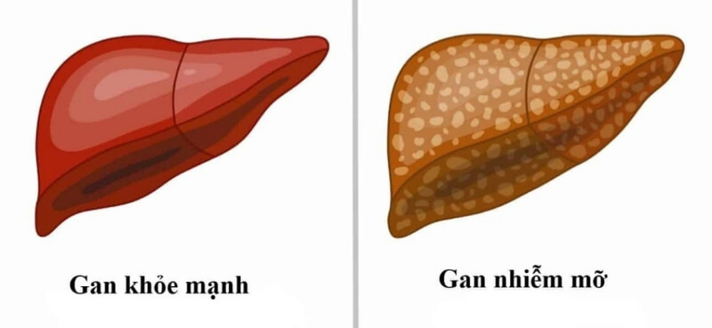 Viêm Khớp Vảy Nến 3