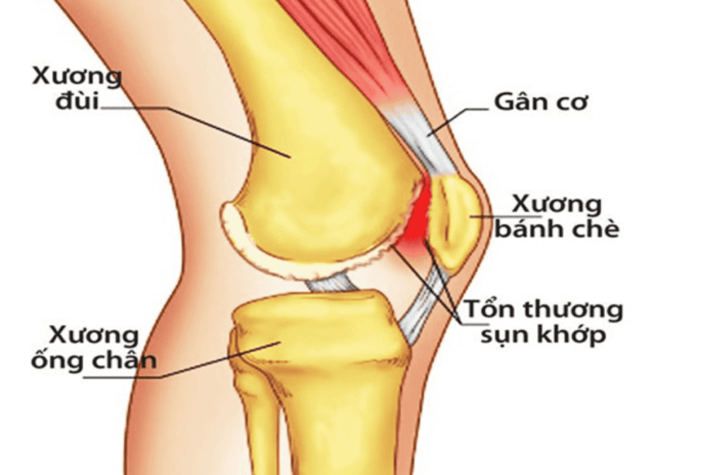 Hình ảnh cấu tạo khớp gối, các bộ phận như xương đùi, xương chày, sụn khớp, gân cơ, xương bánh chè.