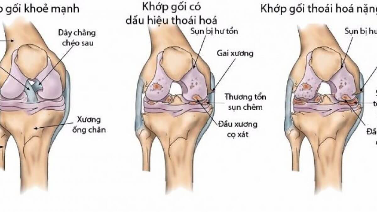 Sụn Khớp 1