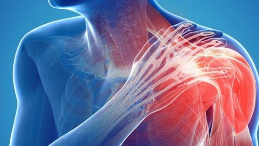 Hình ảnh mô tả viêm khớp vai, đau và sưng tấy nang vai, giúp hiểu rõ vấn đề.