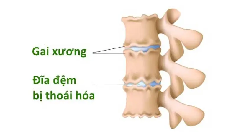 Xương Gai Cột Sống