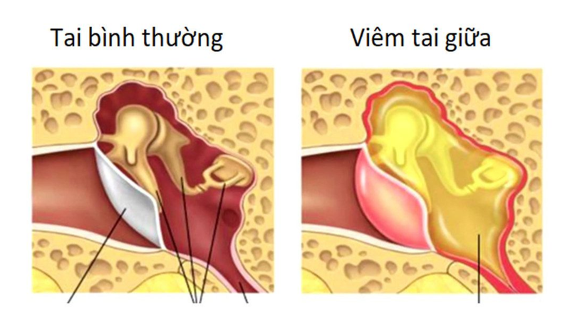 Xương Chũm 4