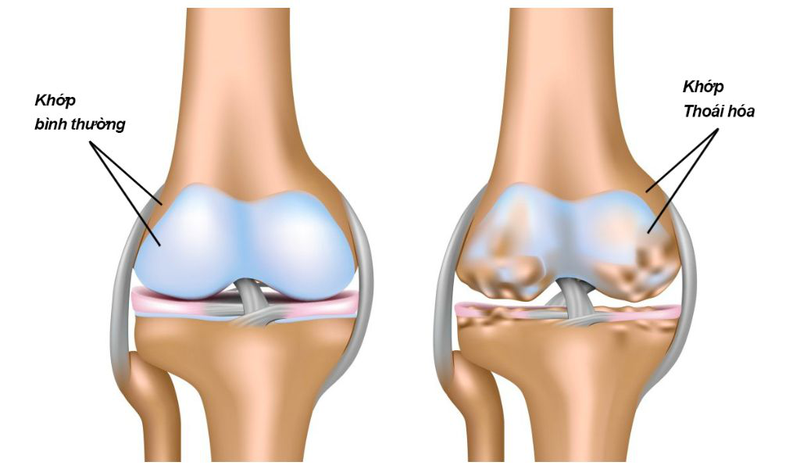 đau Nhức Xương Khớp ở Người Trẻ 2