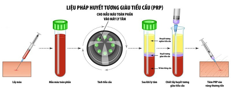 Huyết Tương Giàu Tiểu Cầu