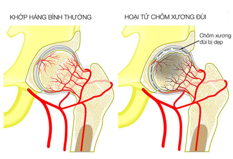 Hoại Tử Chỏm Xương đùi 1