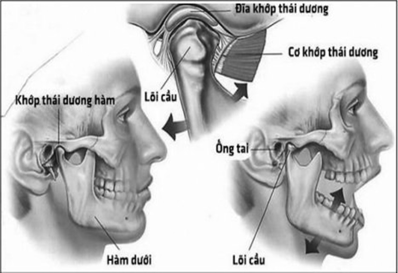 Rối Loạn Khớp Thái Dương