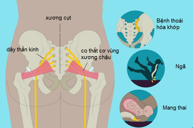 Xương Cụt 4